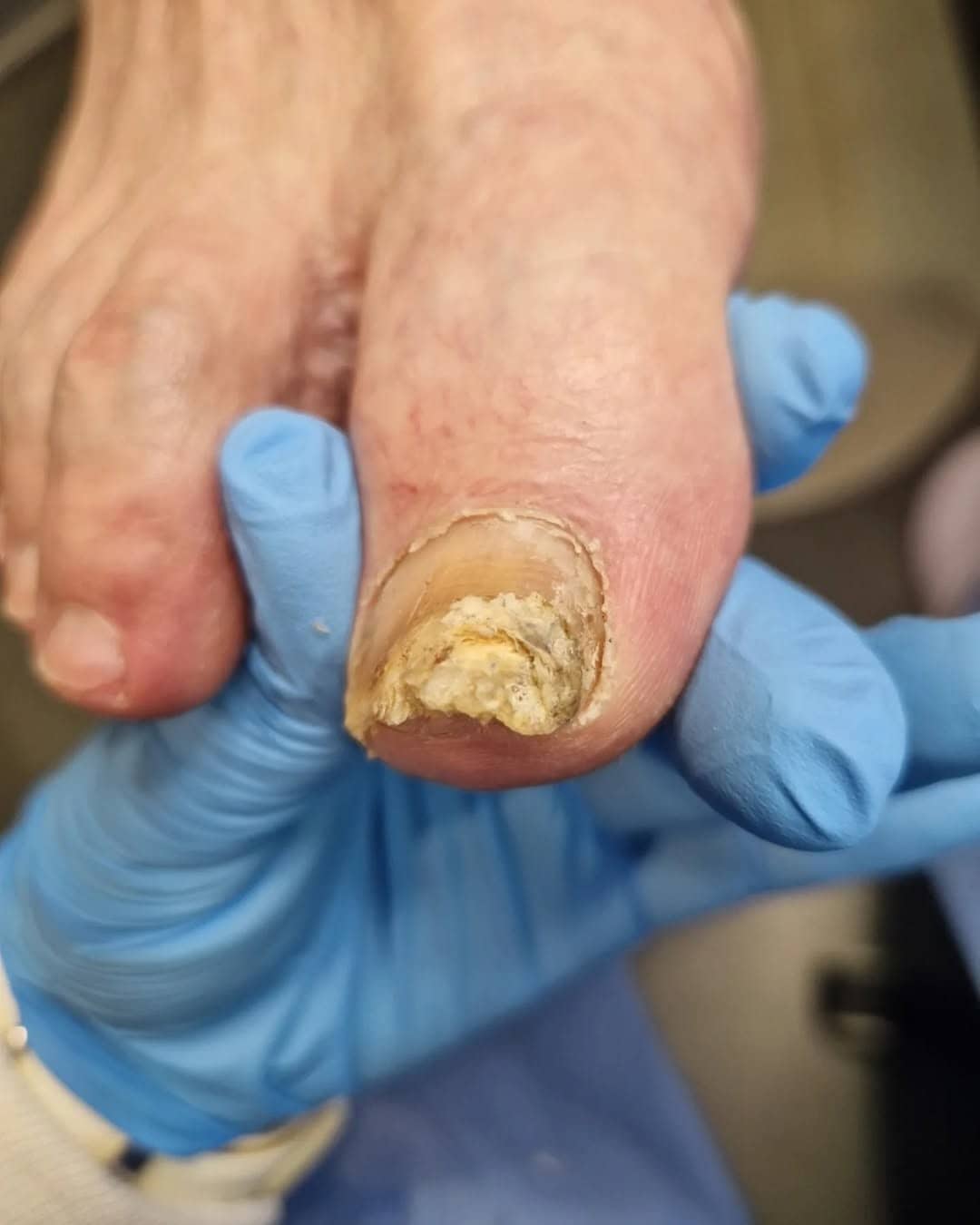 Leczenie grzybicy paznokci