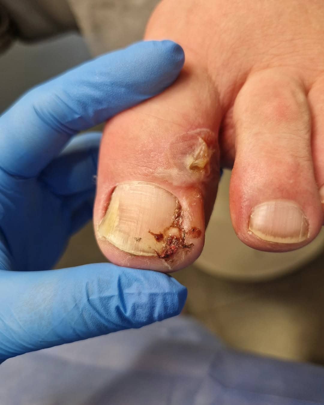 Leczenie wrastających paznokci